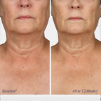Obagi ELASTIderm Neck and Decollete Concentrate