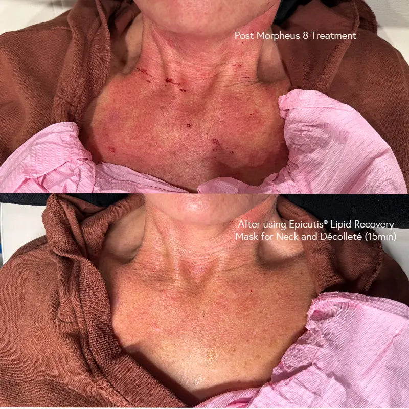 Epicutis Lipid Recovery Mask for Neck + Décolleté 5 x 20ml