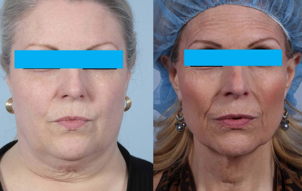 Patient showing Ozempic face volume loss before and after treatment in the Cotswolds